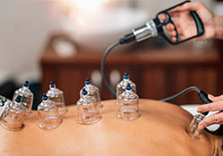 Cupping Clinic In Doha Qatar